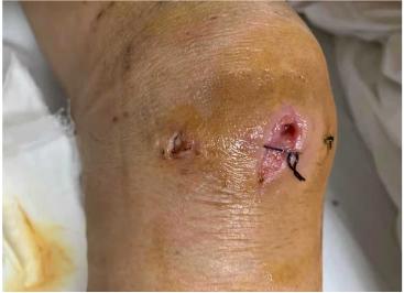 60岁阿姨被缝线针戳破膝盖,引发感染,住院治疗1个月