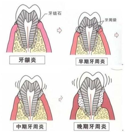 牙疼都是感染到牙髓吗,牙疼坏到牙髓了咋办