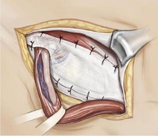 腹股沟疝怎么治,什么是腹股沟疝气啊