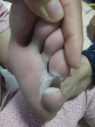 治疗脚气的最佳偏方,治脚气的偏方是不是假的