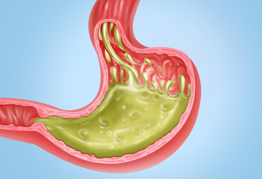 十二指肠球部霜斑溃疡有什么症状,十二指肠球部溃疡症状会后背疼吗