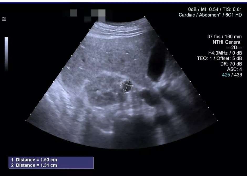 如何从b超看肾囊肿的良恶性,肾囊肿b超怎么判断是肾癌