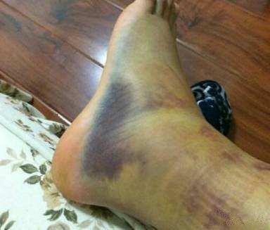 踝关节扭伤怎么处理呢,踝关节损伤后的紧急处理