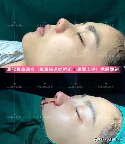 最自然的小翘鼻,鼻综合小翘鼻图片