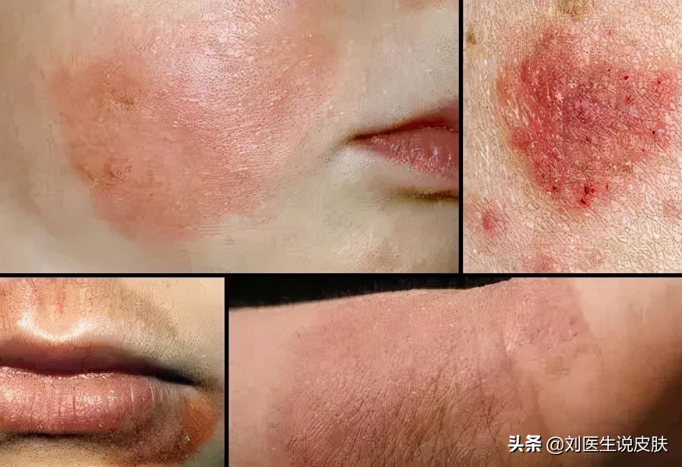 反反复复的湿疹是慢性湿疹吗,湿疹反复怎么调理身体