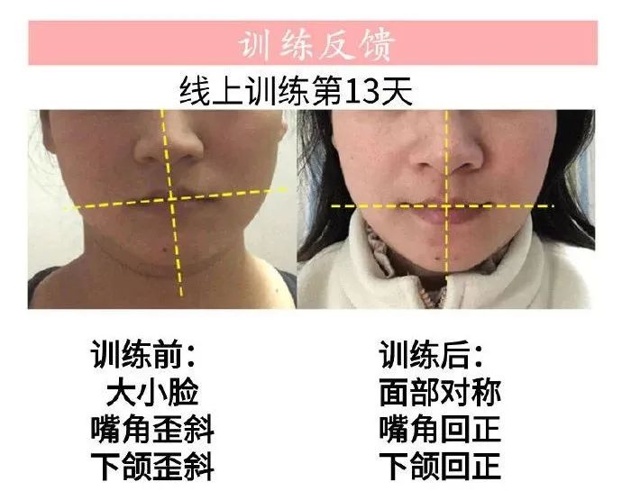 面部不对称程度怎么界定,高低肩会影响面部吗