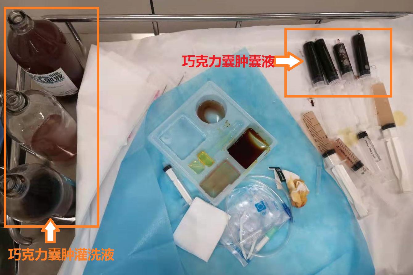 卵巢巧克力囊肿穿刺好还是手术好,穿刺治疗巧克力囊肿效果评价