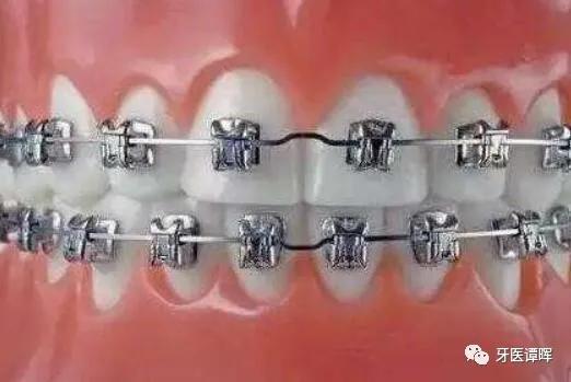 超详细的牙齿矫正过程,重叠牙齿矫正变化过程