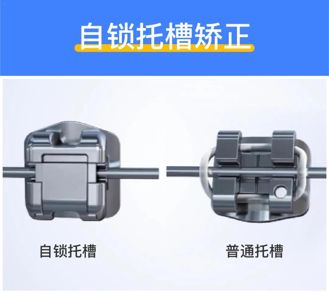 揭秘矫正牙齿多少钱,牙齿矫正全过程价格