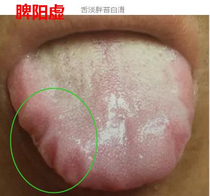 脾气虚和脾阳虚脾虚湿盛的区别,脾虚百病生脾虚有哪些表现