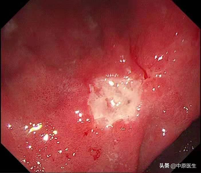 胃部怀疑是溃疡，细心专家又选择窄带光放大检查发现是胃癌