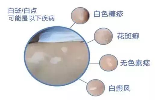 孩子脸花一块白一块怎么回事,小孩脸上花一块怎么回事