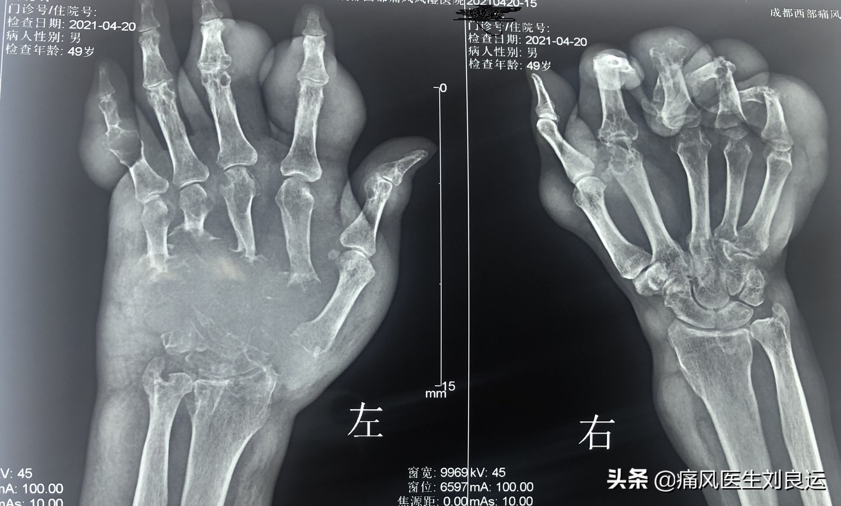 痛风富贵病,饮食很清淡但犯痛风了