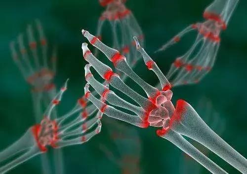 类风湿膝关节炎能做哪些运动,类风湿关节炎病人不能干家务吗