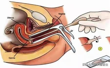 20岁女性得宫颈癌的前兆,20岁就得宫颈癌前病变