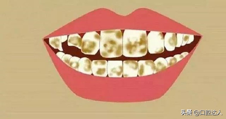 不吃糖按时刷牙为什么牙齿还会坏,为什么都按时刷牙了牙齿还那么黄