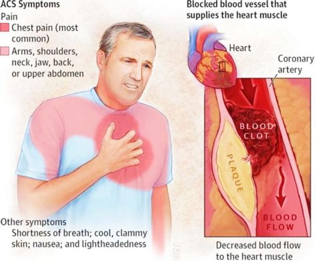 肩膀疼痛要警惕的三种病怎么治疗,肩膀疼痛要警惕的病怎么治疗