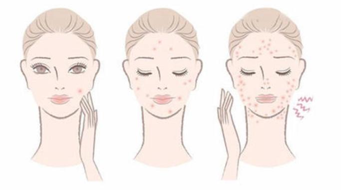 长痘不要惊慌教你自救小妙招,长痘怎么正确处理