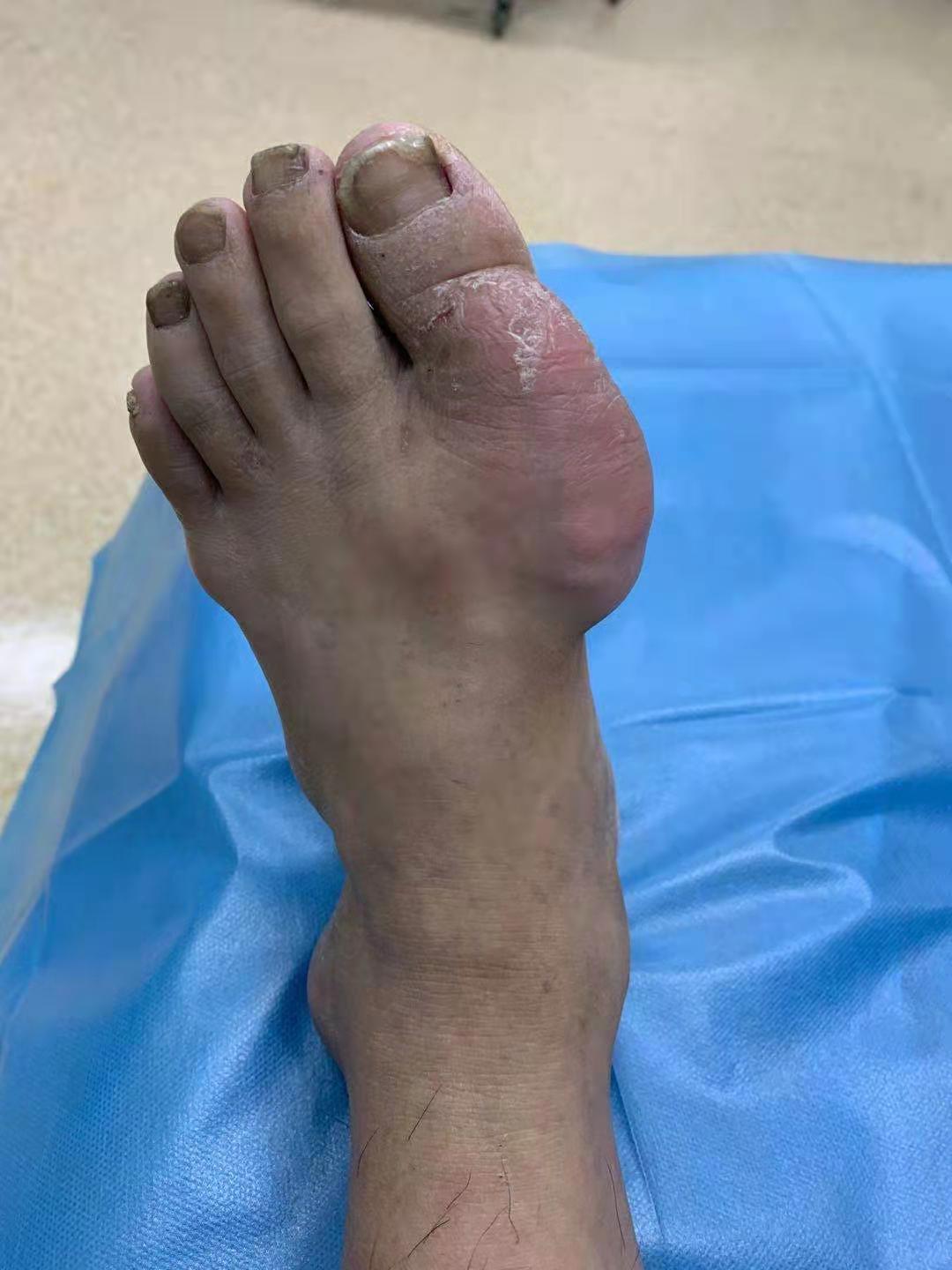 27岁抽血检查说尿酸有点高怎么办,尿酸接近正常最高值430怎么办