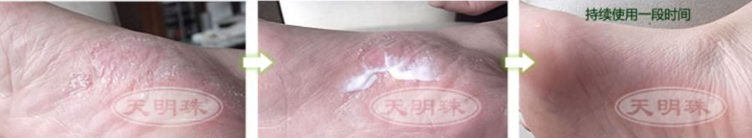 冬天脚跟干裂又起皮怎么办,冬天脚跟干裂起硬皮擦什么保湿好