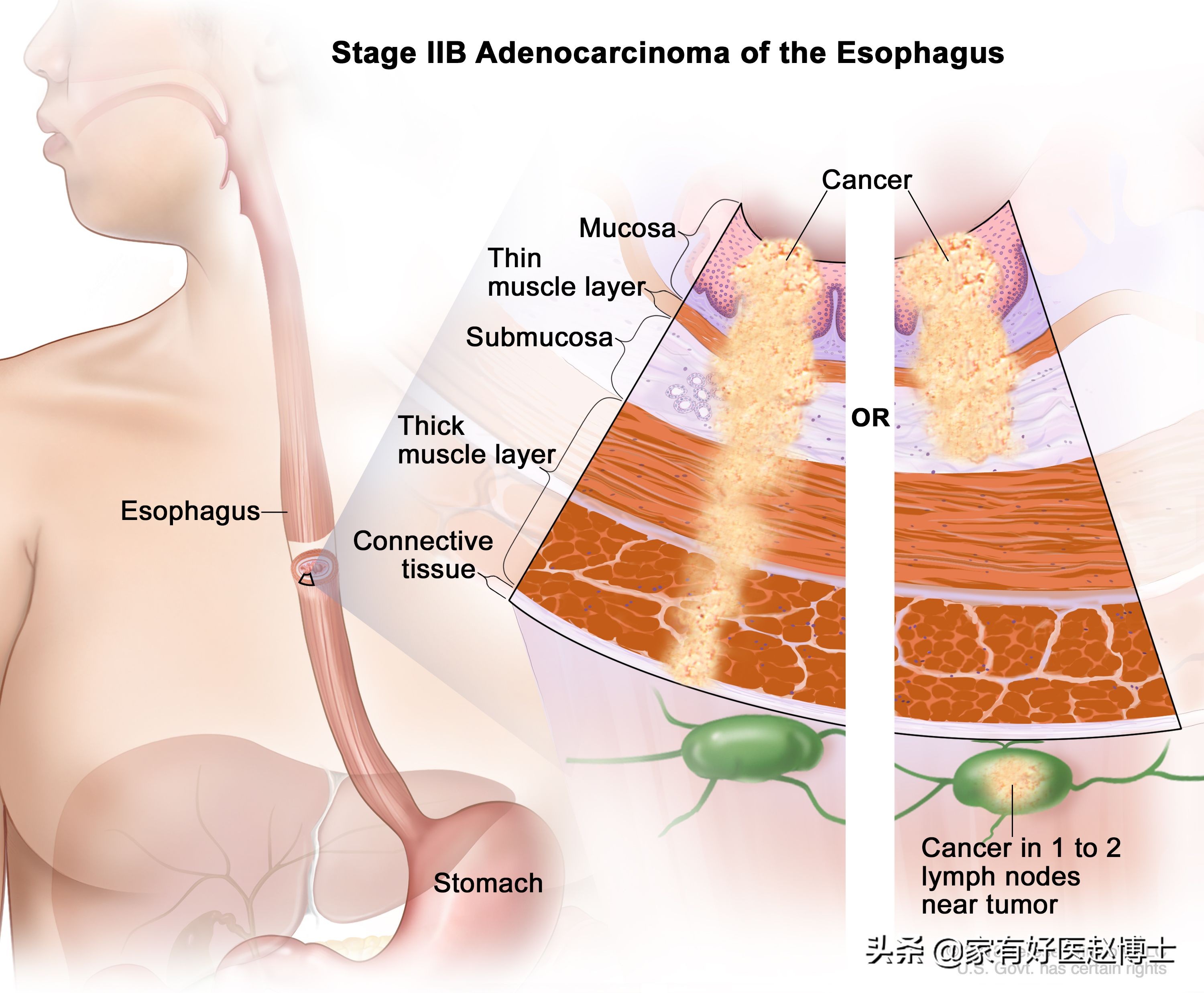 六大高发癌症早筛攻略,六大癌症有哪些