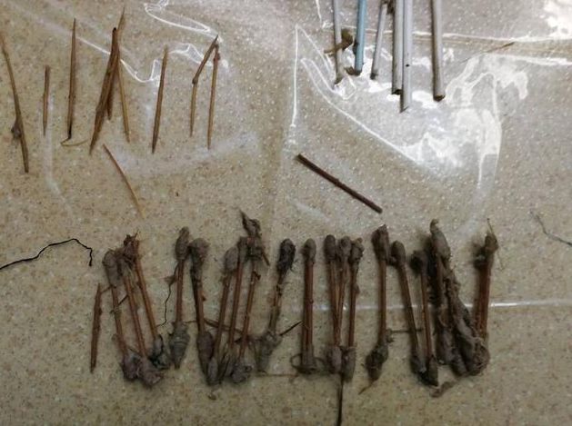 二十岁男孩腹痛住院手术取出,9岁小孩腹痛取出来的东西