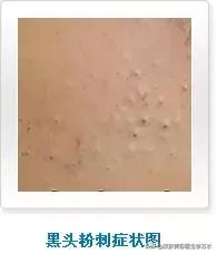 痘痘十大真相,痘痘大全图解