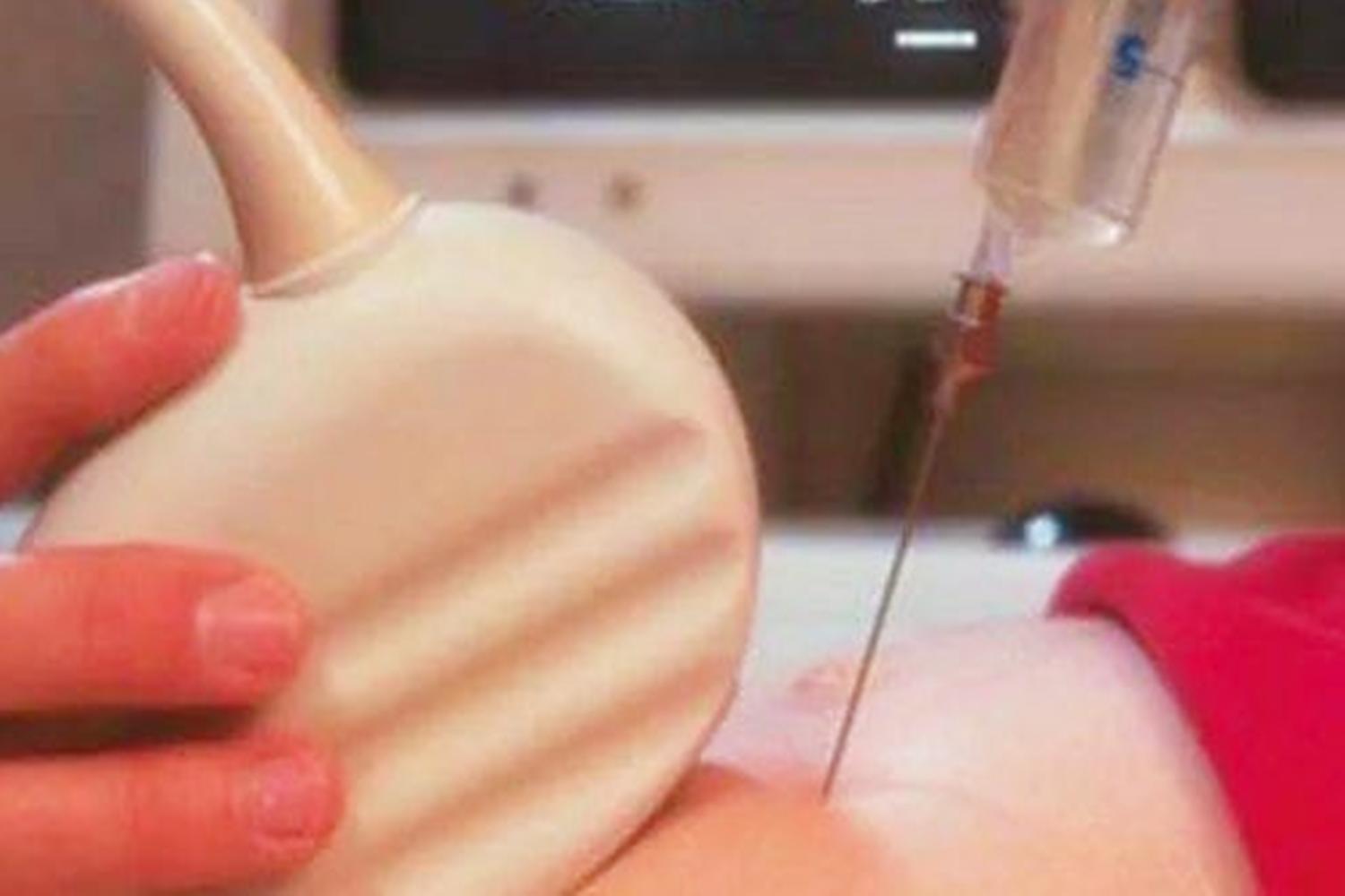 在孕期，什么情况下需要做羊水穿刺？了解后没必要过分担心