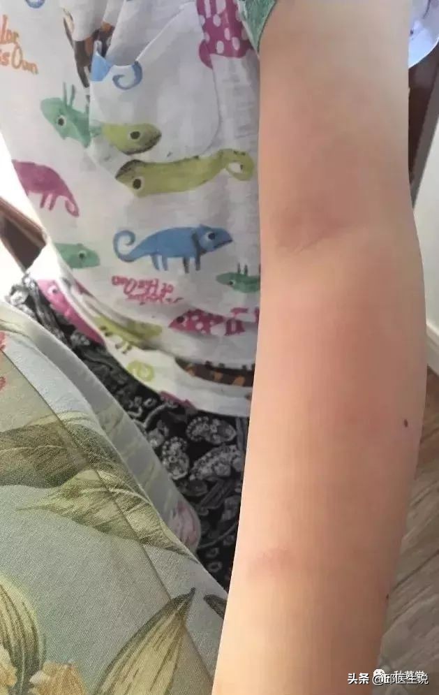 皮肤瘙痒的外洗中药,中药外洗治疗顽固性皮肤瘙痒