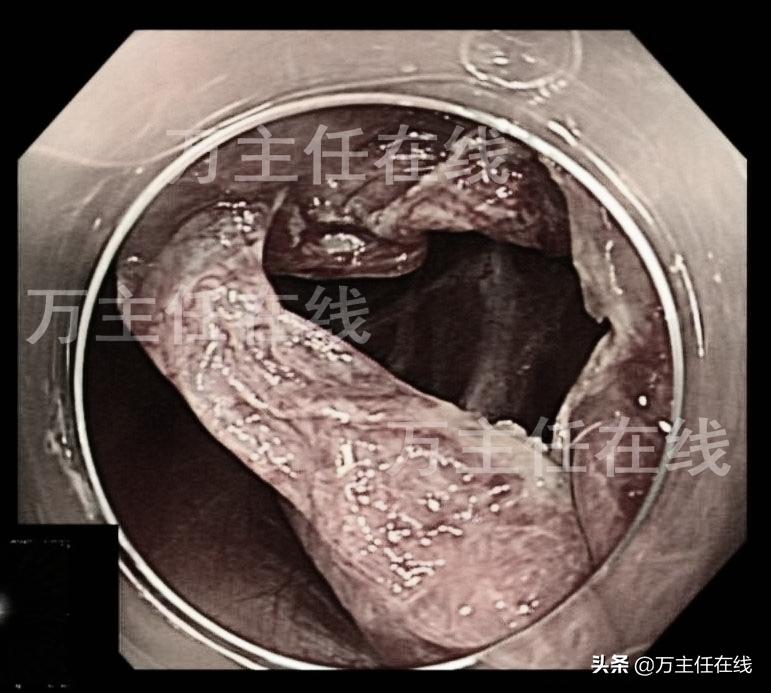 消化内科肝脏手术,肝部囊肿切除手术
