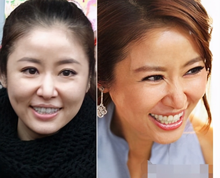 法令纹显老10岁三种方法帮助缓解,法令纹怎么消除4妙招告别衰老