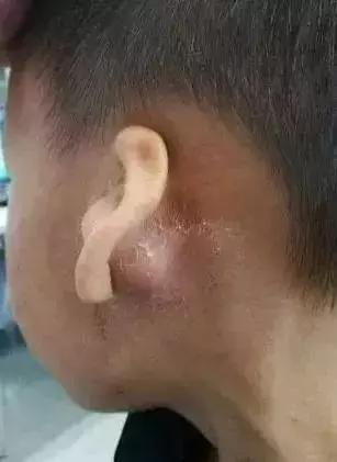 儿童中耳炎怎么判断严重程度,孩子中耳炎医生让输液