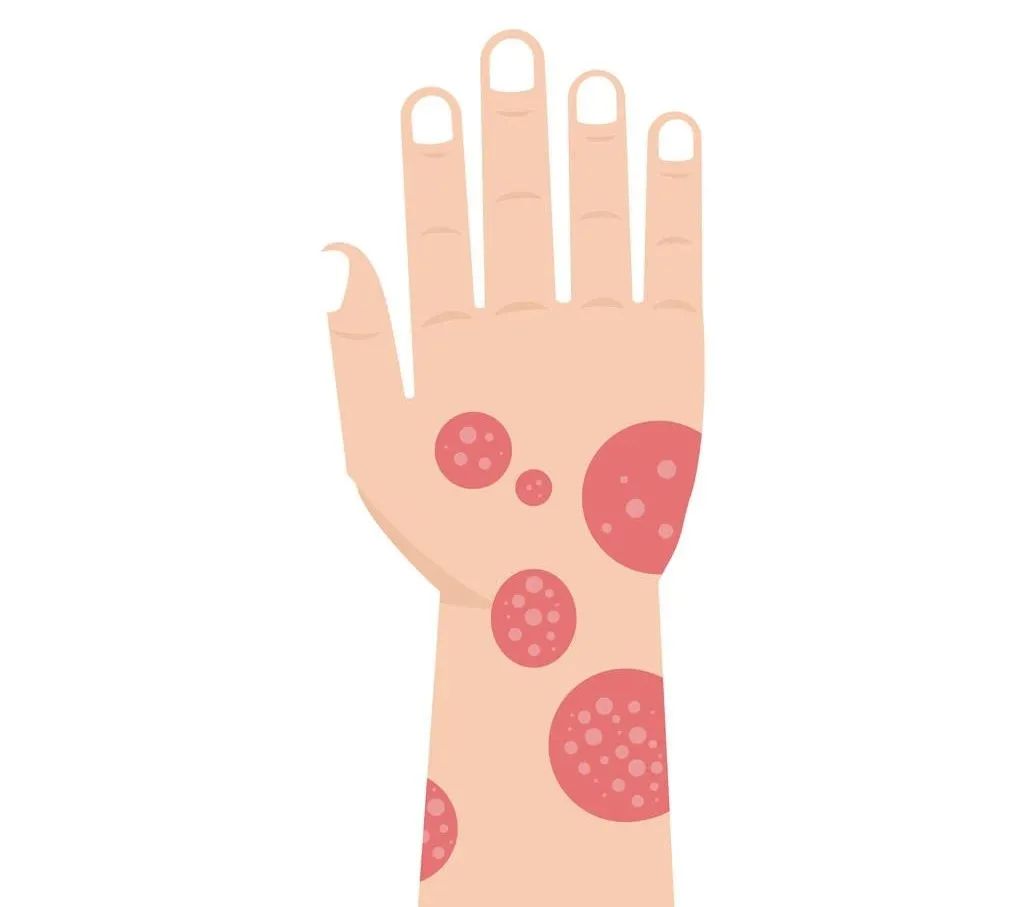 手上有脚气起小水泡痒还干裂,脚气痒脱皮会传染到手肘吗