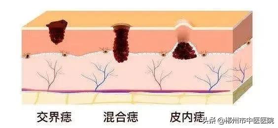 色素痣上有黑点是怎么回事,长色素痣要注意什么