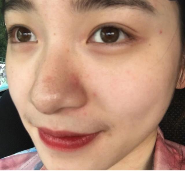 鼻子黑头毛孔粗大怎么去除,鼻子黑头严重毛孔粗大怎么办