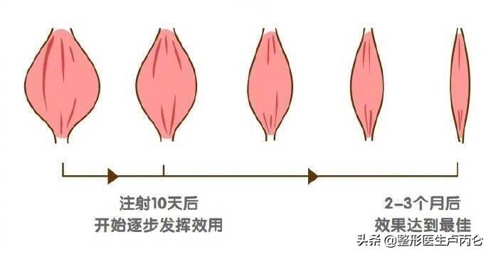 肉毒素瘦咬肌是让咬肌空隙变小吗,肉毒素注射后咬肌突出怎么办