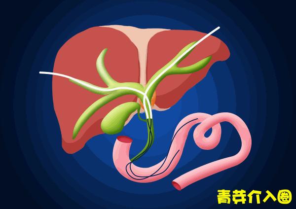 胆道阻塞眼睛发黄图片,胆管堵塞全身发黄中医治疗