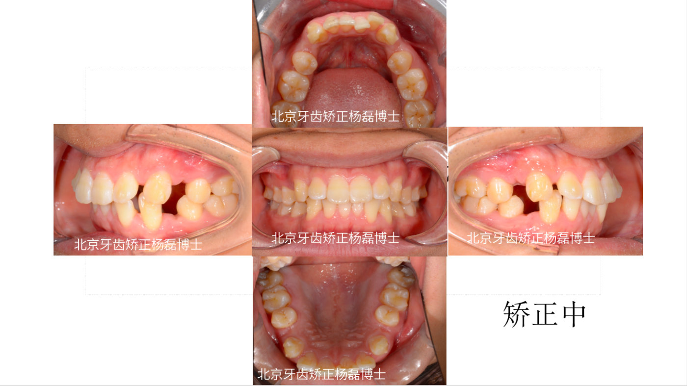 正畸医生杨磊,北大口腔医院修复科杨磊