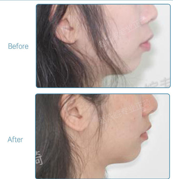 杭州牙齿矫正的全过程,杭州牙齿矫正哪个医生最好