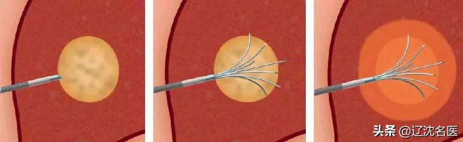 巨块肝癌最新治疗方法,肝癌介入治疗方法