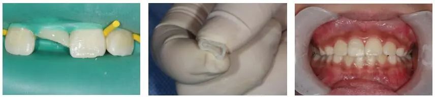 牙齿断了把牙根拔出,牙齿断了拿另一半能补吗