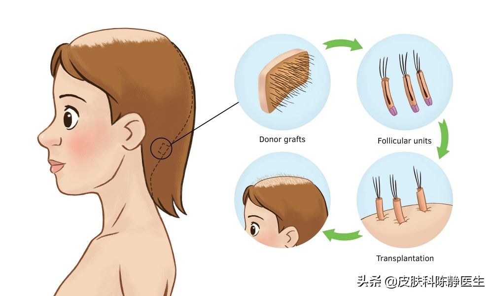 脱发最新研究成果与最新治疗方法,女性脱发严重怎么治疗才有效