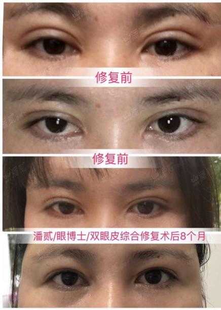 双眼皮手术后眼神凶狠是什么原因,双眼皮手术后显凶