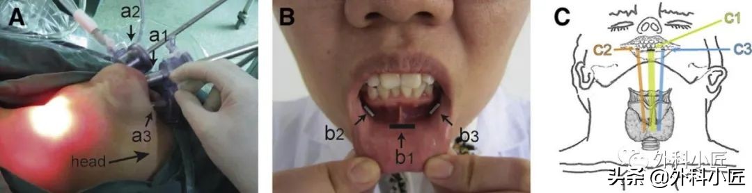 腔镜甲状腺切除手术专家共识,经胸入路甲状腺手术专家共识2019