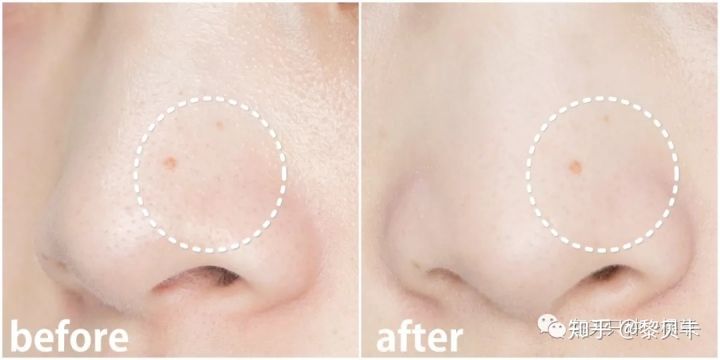 黑头去除神器排行榜,黑头粉刺清除强力推荐网红产品