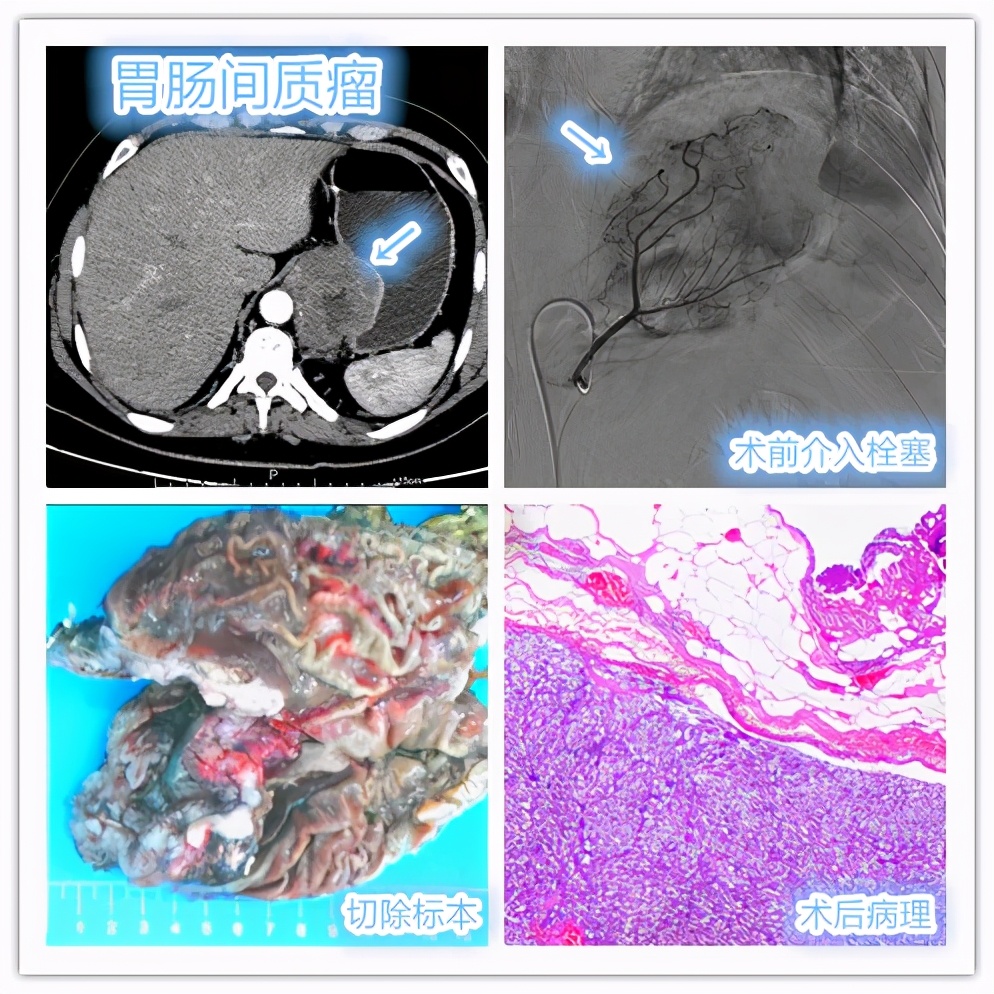 巨大胃肠间质瘤如何通过综合治疗提高疗效？