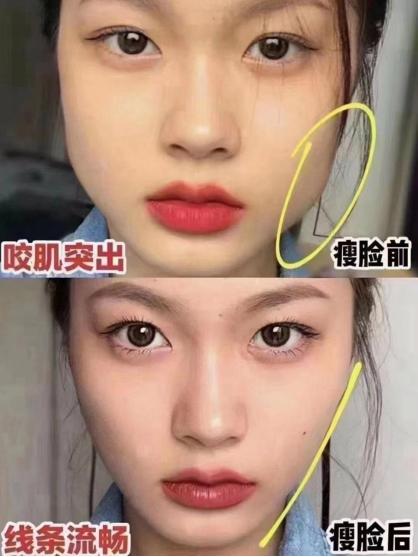 打瘦脸针效果明显,打了瘦脸针效果特别明显对比图
