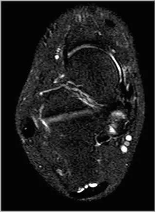 踝关节撞击症问诊,踝关节撞击综合征的x线表现