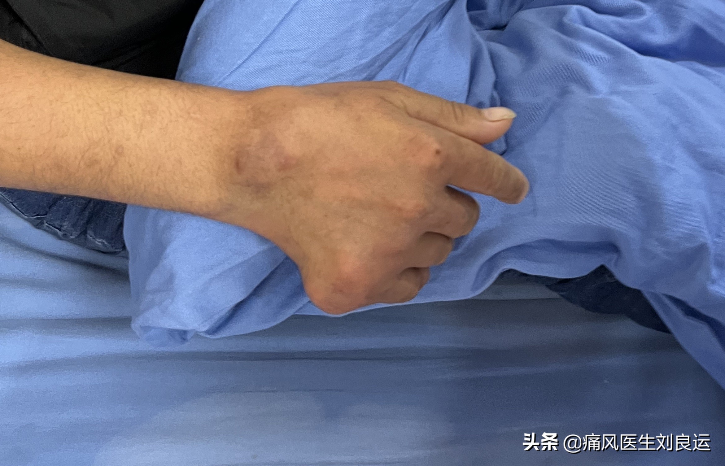 男子扭伤脚后续,原有痛风脚扭伤会诱发痛风吗