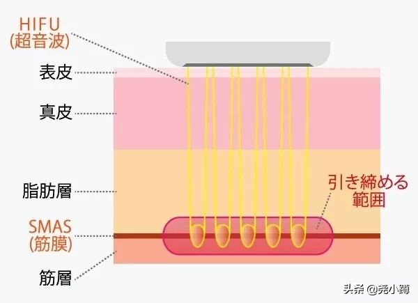 悠兰科普五——超声刀：让您皮肤重回少女感的秘密
